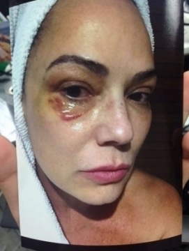 'FUI VÍTIMA DE AGRESSÃO COVARDE', DIZ LUIZA BRUNET; EX-COMPANHEIRO NEGA