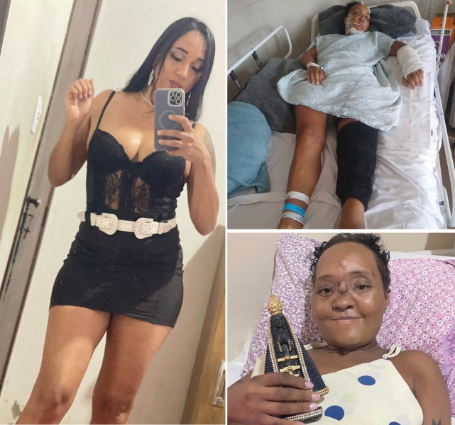 MULHER PERDE PERNA EM ACIDENTE DE MOTO